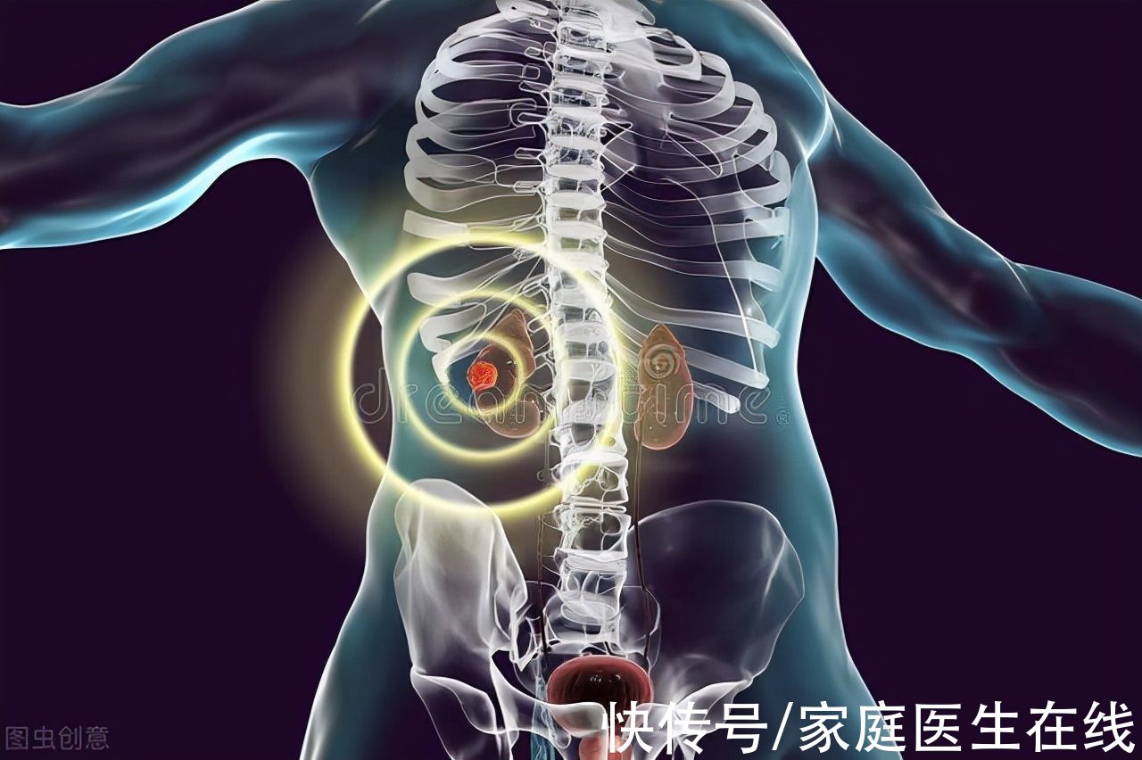 治疗|肾癌的发病率越来越高？了解这6个小常识，早点预防肾癌