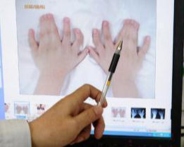 多指症|3个月大的男婴为何长出31根指头?得知原因后母亲崩溃痛哭