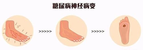 营养神经|甲钴胺片是营养神经的“扛把子”，吃多久能停药？医生正面回答了