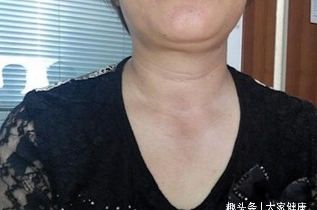 結節|甲狀腺結節別擔心！不妨多吃4種食物，有利于活血散結！
