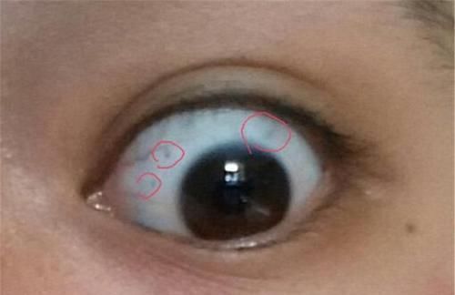 眼白处|3岁女儿眼睛出现“多个黑点”,原因竟是奶奶买的“哄娃神器”