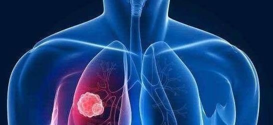 疼痛|肺癌一发现都是晚期错早期往往有蛛丝马迹,是身体在向你求救