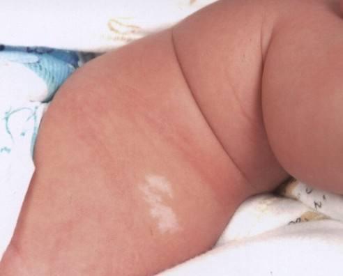 无色素痣|宝宝身上这3种“印记”,可能藏着疾病,发现了要及时去医院!