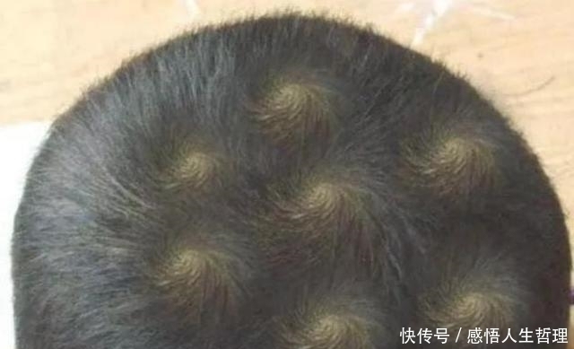 头旋|孩子头上的“旋”的个数,暗示孩子智商高低家长要了解真相
