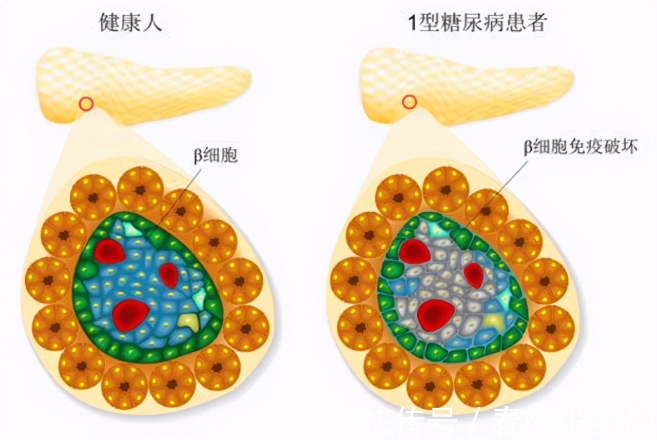 降糖药|糖尿病疫苗要来了每月打一针就能降糖