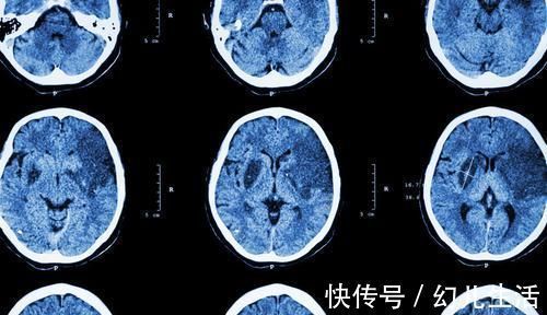 血管内皮|睡觉出现4个异常,说明脑血管堵了,做好4个字,清血脂通血管