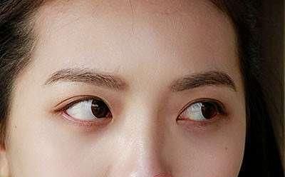 脂肪粒怎么办频繁换眼霜不如用这一招