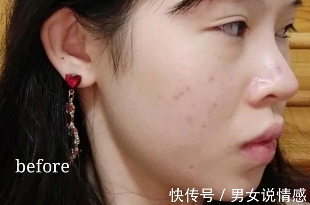 唇部 做什么医美改善凸嘴效果最快!