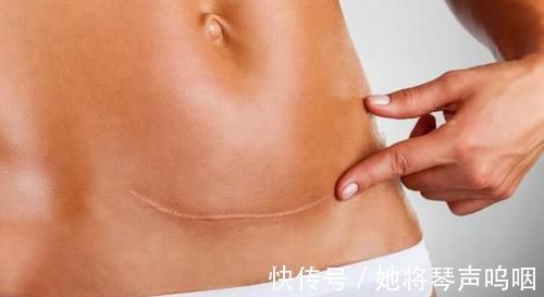 剖腹产|产检时,医生会问“头胎还是二胎”,这里面的小九九可要知道