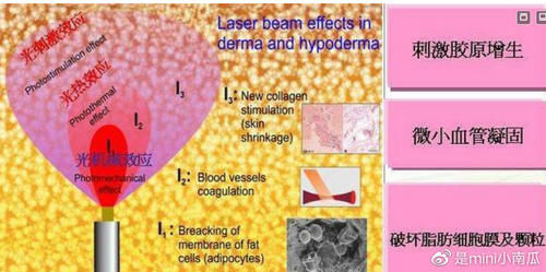 光纤溶脂瘦脸可靠吗？术后多久能看到效果？