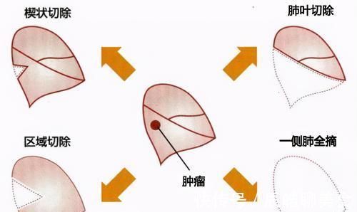 肺结节|可以让肺结节消除或者不长大吗?为什么一定要随访?