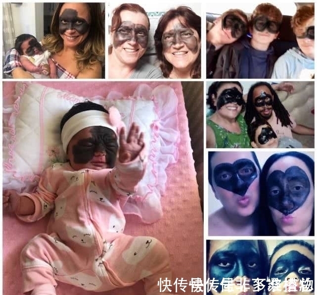 胎记|7个月婴儿脸上因巨大黑色胎记爆红!像带着“蝙蝠侠”面具!