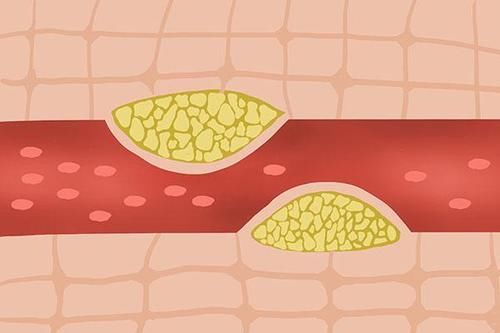 颈部|颈动脉彩超后，发现斑块，能按揉颈部吗？会引发斑块脱落吗？