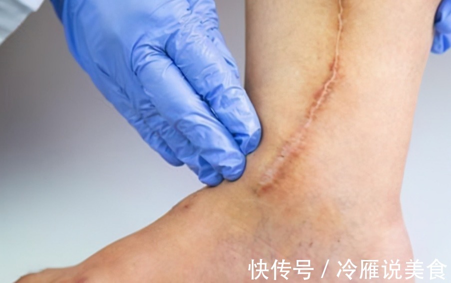 指标|腿是第二个心脏!胆固醇有没有超标不要查血脂,腿上就有信号
