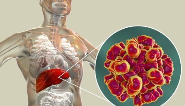 胆红素|发生肝硬化后,身体会有的4种表现,一定要了解