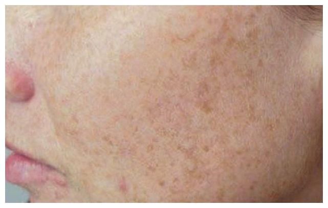 35岁女子激光祛斑遭毁容，皮肤科医生：风险太大，建议这样保守祛斑