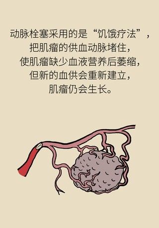 切除|得了子宫肌瘤就一定要切除？看看医生怎么说