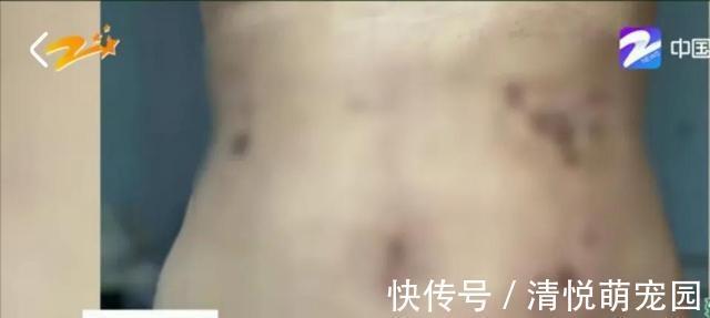 减肥药 体重100斤美女做抽脂手术,哭诉:我老公都不敢碰我的肚子