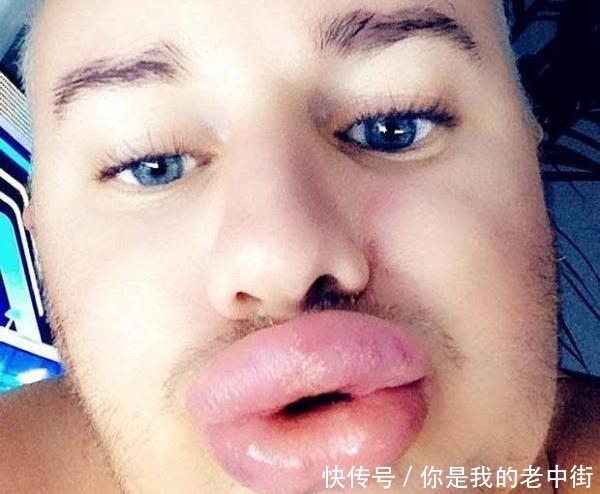 32岁男子花4万多做丰唇手术,结果像挂了两根香肠