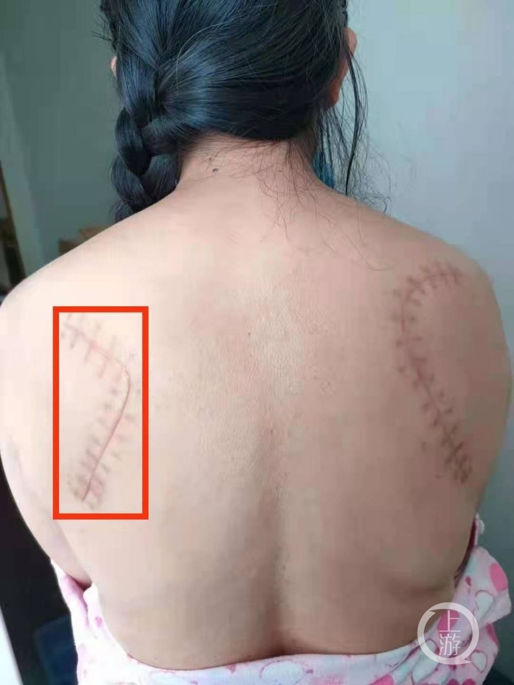 医务科|湖北51岁女士右肩胛骨折，主刀医生却给其左肩胛开了刀