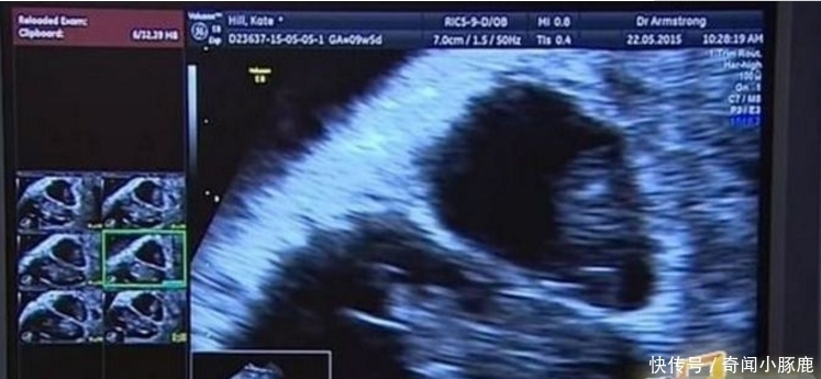 怀孕|女子与丈夫同房3个月内竟怀孕两次,得知真相后令人惊讶不已