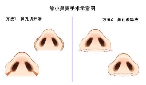 价钱 鼻头缩小手术价钱具体是多少?1万块能做得很好吗?