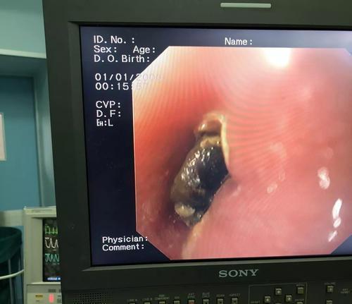 体温计|娃误食纽扣电池,妈妈“大题小做”的处理保住孩肠道,医生都称赞