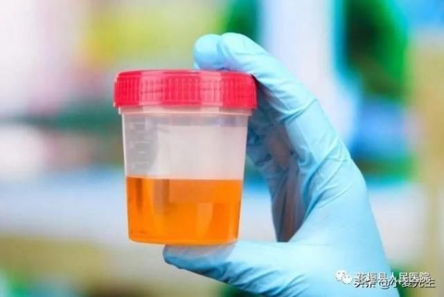 高尿酸的祸根找到了,平时少吃1黄2白,并做好3事,尿酸稳稳的
