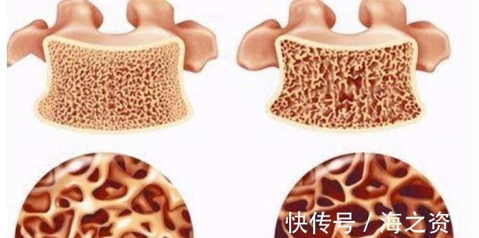 郑大哥|医生提醒:3种食物或是骨质疏松“发物”,骨不好的尽量少吃