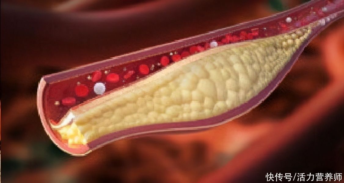 慢性疾病|“低压高”与“高压高”哪种更危险？应该如何判断？别看错了