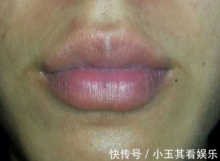 美白|嘴唇周围发黑是怎么回事?如何美白呢?