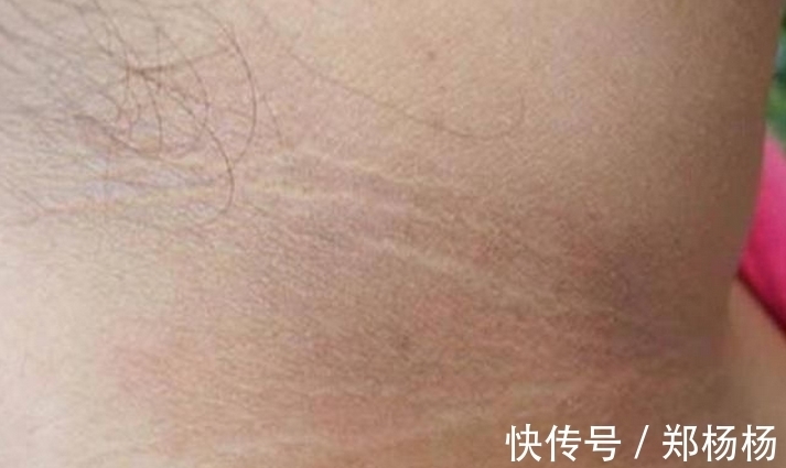 假性黑棘皮病|6岁小女孩脖颈发黑洗不掉,去医院做检查,医生的话让妈妈笑了