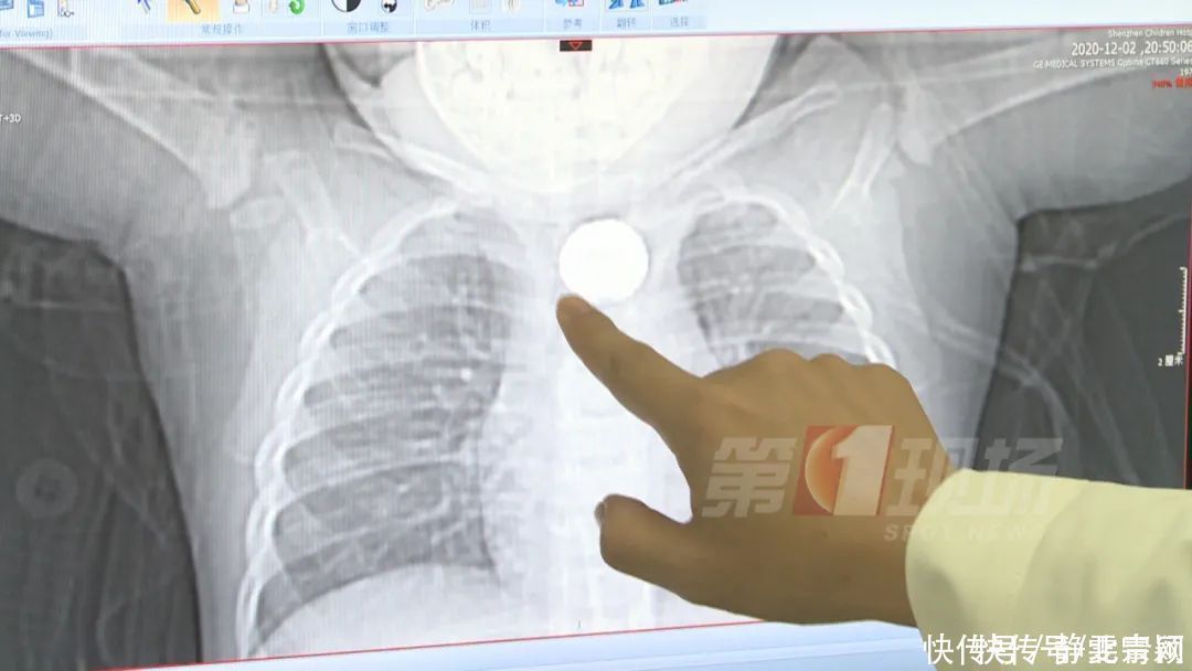 吴泽斌|家长一不留神,1岁男童食道被腐蚀!当心这些致命危险…