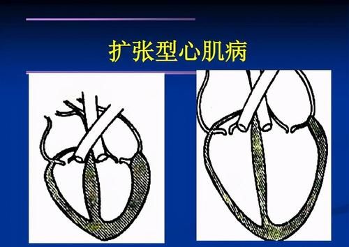 什么叫做限制性心肌病？患病原因是多样性的，要及时采取治疗方法