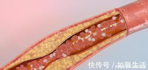机体|中国高血压人群这么多,到底是因为什么?其实多是一种饮食习惯