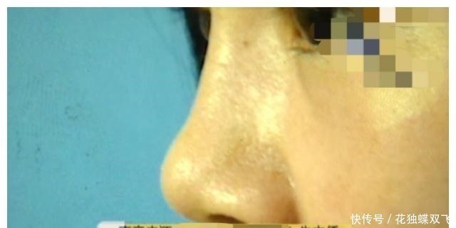 鼻子|整形三年,老公也忍不了了花钱整成猪一样!女子曝光求助