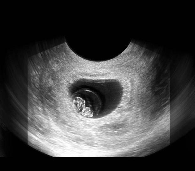 性别|胎儿从卵泡到性别形成,17张图片清晰诠释,男宝女宝看得很清楚