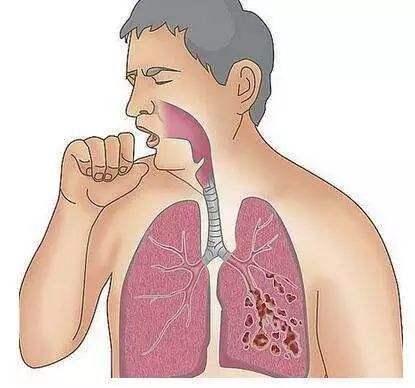 老李|46岁男子,不痛不痒,查出肺癌,手上1个标记,提示已到中晚期