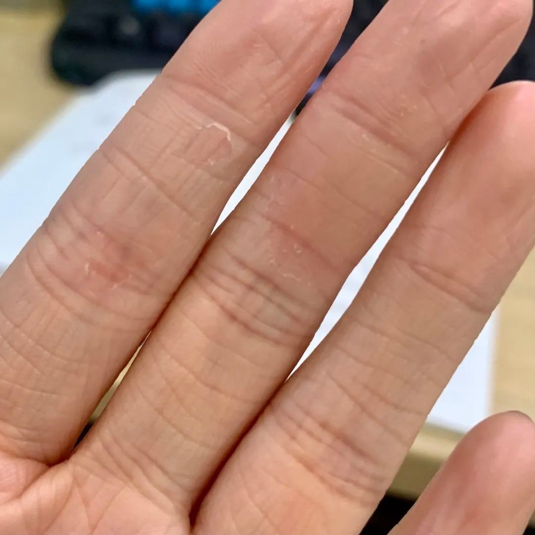 掌跖脓疱病|宝，听说你最近在脱皮？脱什么皮？