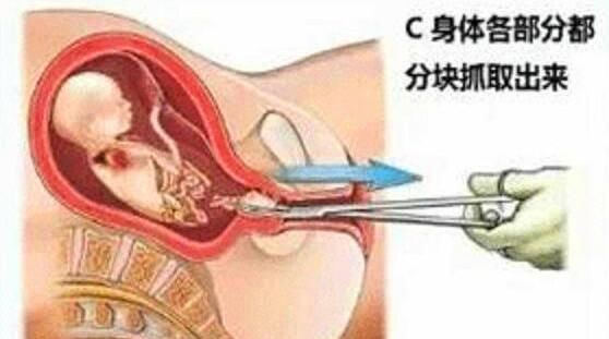 流产|朋友意外怀孕要人工流产,看到这组流产过程图,她哭了