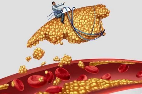 高血脂疾病|血脂偏高的人，不能吃面条吗？想要血脂平稳，建议少吃三种素食