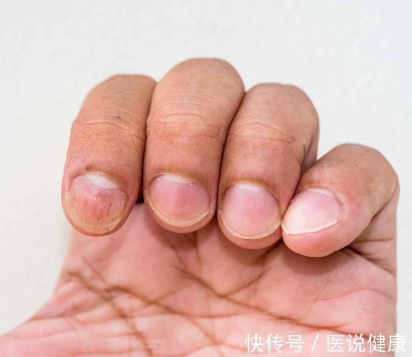 末端|肺不好,手先知”!手部出现4个异常,说明肺出问题了,及时检查