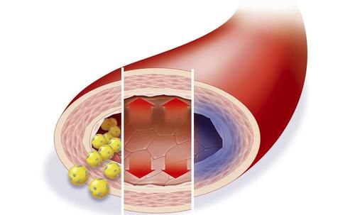 临床研究|吃药降血脂，血脂降下来了，药还吃不吃？
