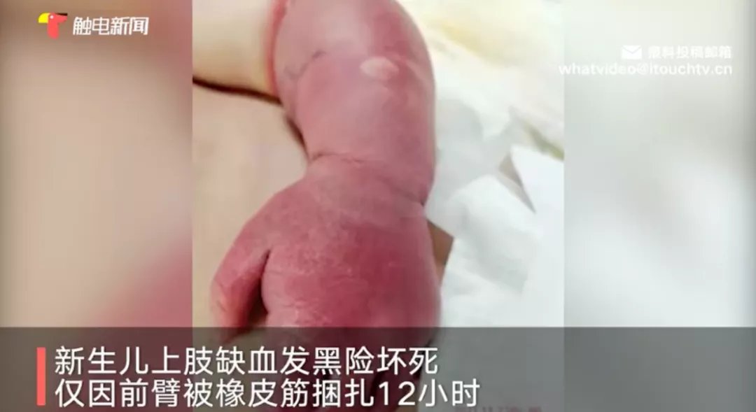 橡皮筋|触目惊心！刚出生1天的宝宝险被截肢，只因妈妈一个疏忽…