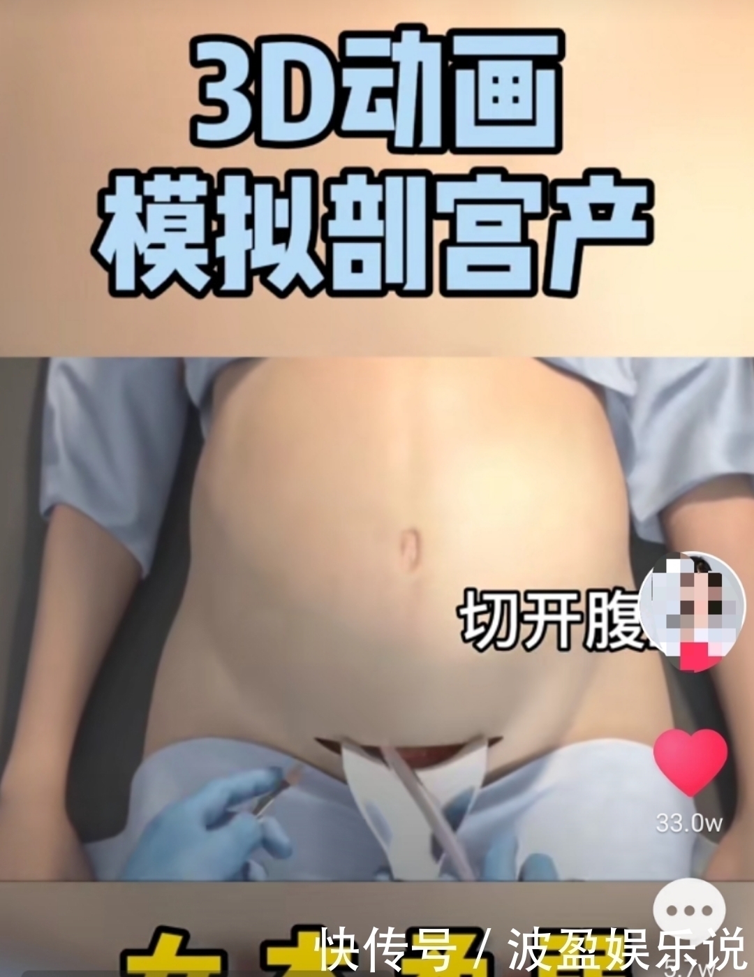 麻醉|剖宫产有多“伤”妈妈,几张3D过程图带你了解,感恩老婆和妈妈