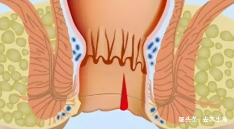 肠道|放屁很多不是肠癌！消化科医生提醒3个信号是关键，很多人不懂