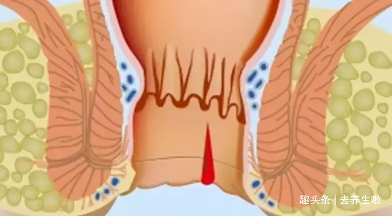 肠道|放屁很多不是肠癌!消化科医生提醒3个信号是关键,很多人不懂