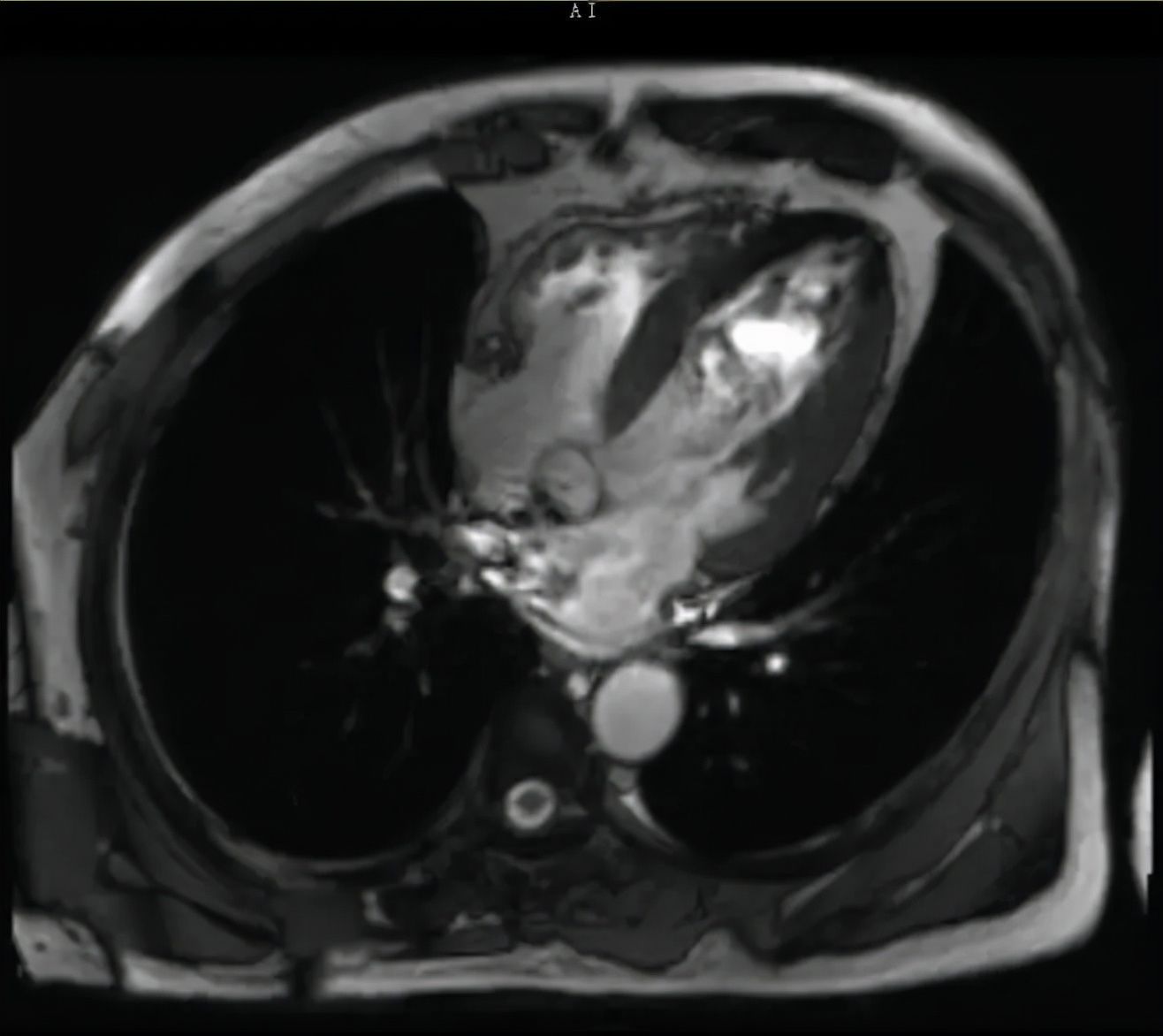心脑血管疾病|30岁男子高血压致急性心衰,停药半年心脏“膨胀”一倍