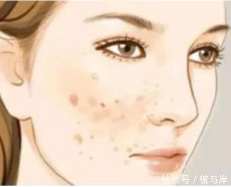 不断长痘,如何防止痘印满脸?困扰很多人的问题终于有了答案