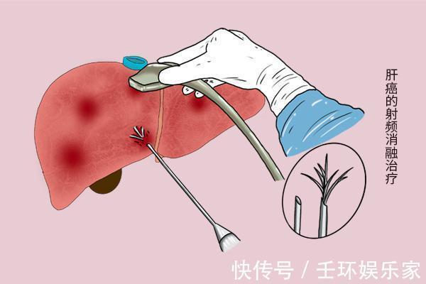 养分|癌细胞已经扩散,食欲、精神却很好,体重也增加,是什么原因